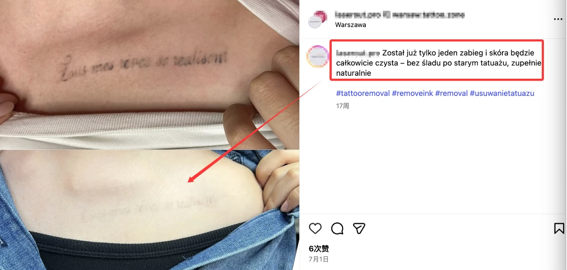 tattoo removal before and after tattoo removal before and after