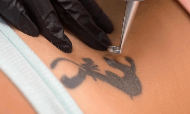 Q-Switched laser tattoo removal Q-Switched laser tattoo removal